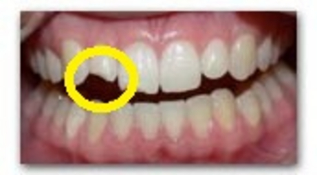rottura del dente