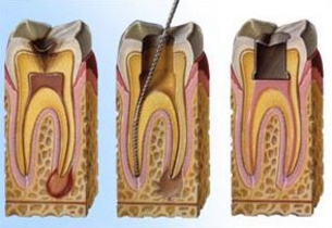 Terapia canalare