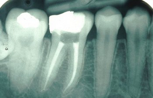 Endodonzia