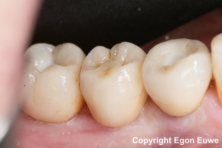 Ponte in zirconio