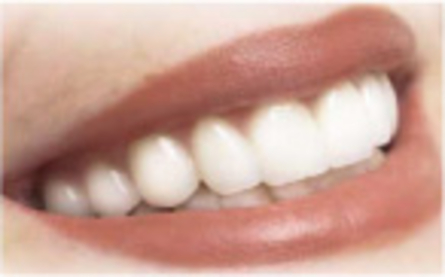 Sbiancamento denti